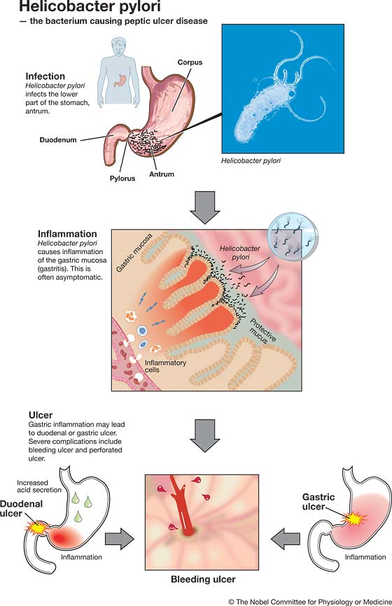 helicobacter pylori